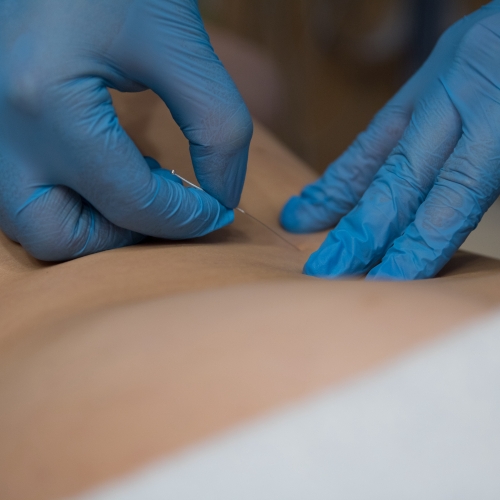 dry-needling-breckenridge-co-physical-therapy-clinic