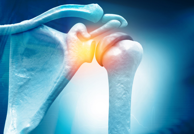 Thawing Your Frozen Shoulder With Physical Therapy