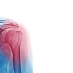 Physical Therapy for Shoulder Injury Recovery: What to Expect