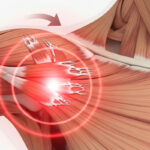 rotator cuff injury